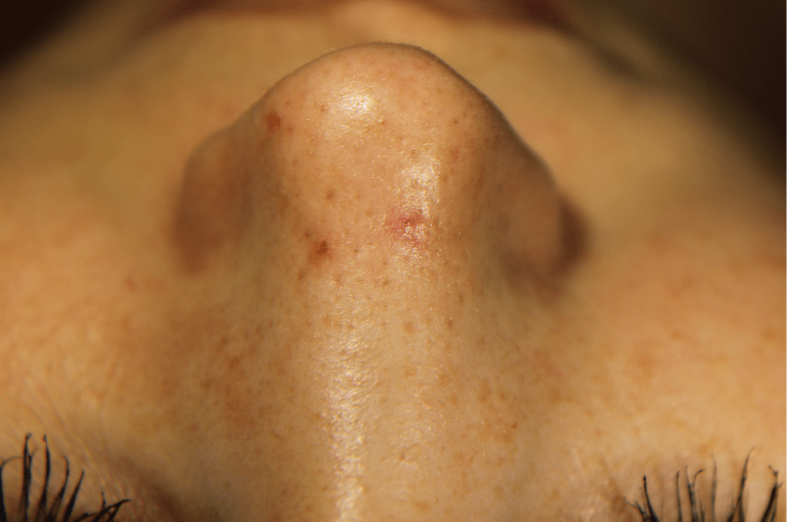 Wat is spider naevus? Laserkliniek